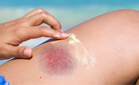 Hirudoid - scars treatments