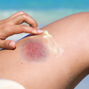 Hirudoid - How Hirudoid heals bruises